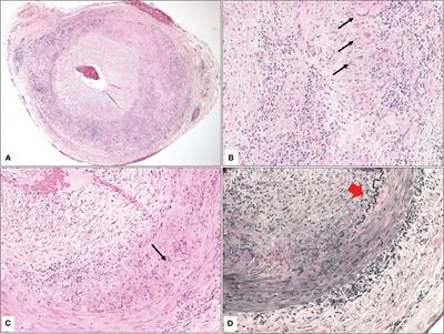 Giant cell temporal arteritis: a clinicopathological study with emphasis on unnecessary biopsy